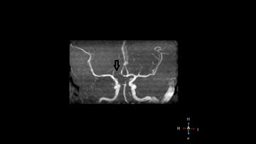 Hypoplasia of the right A1 segment