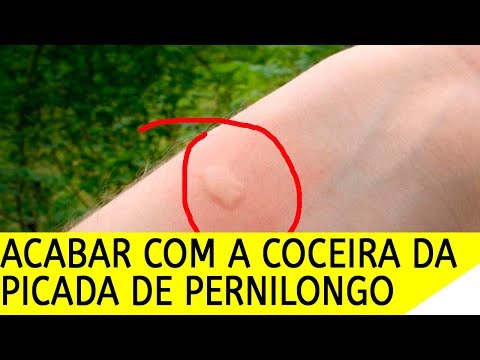 Vídeo: Como Ungir Uma Picada De Mosquito Para Não Coçar, Em Casa