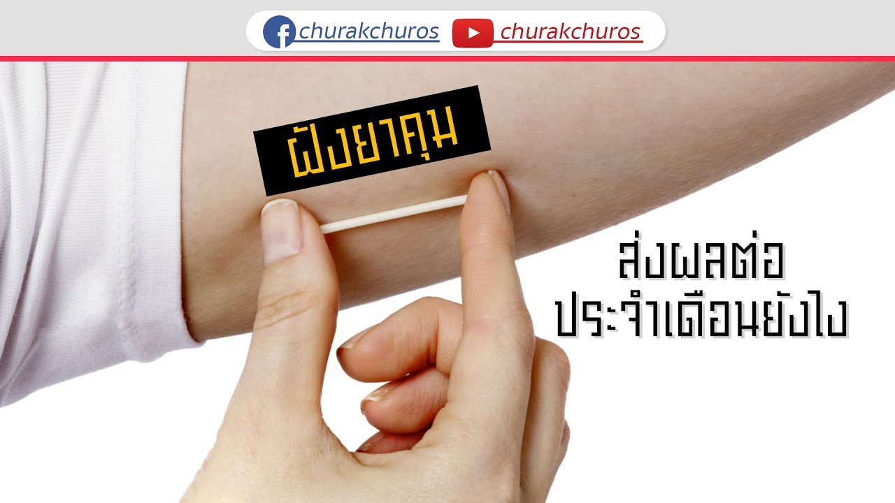 ฝังยาคุมกำเนิด ส่งผลต่อประจำเดือนยังไง ?