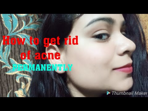 HOW TO GET RID OF ACNE PERMANENTLY.  BEST TIPS FOR ACNE AND PIMPLES. HOW TO GET CLEAR SKIN INSTANTLY