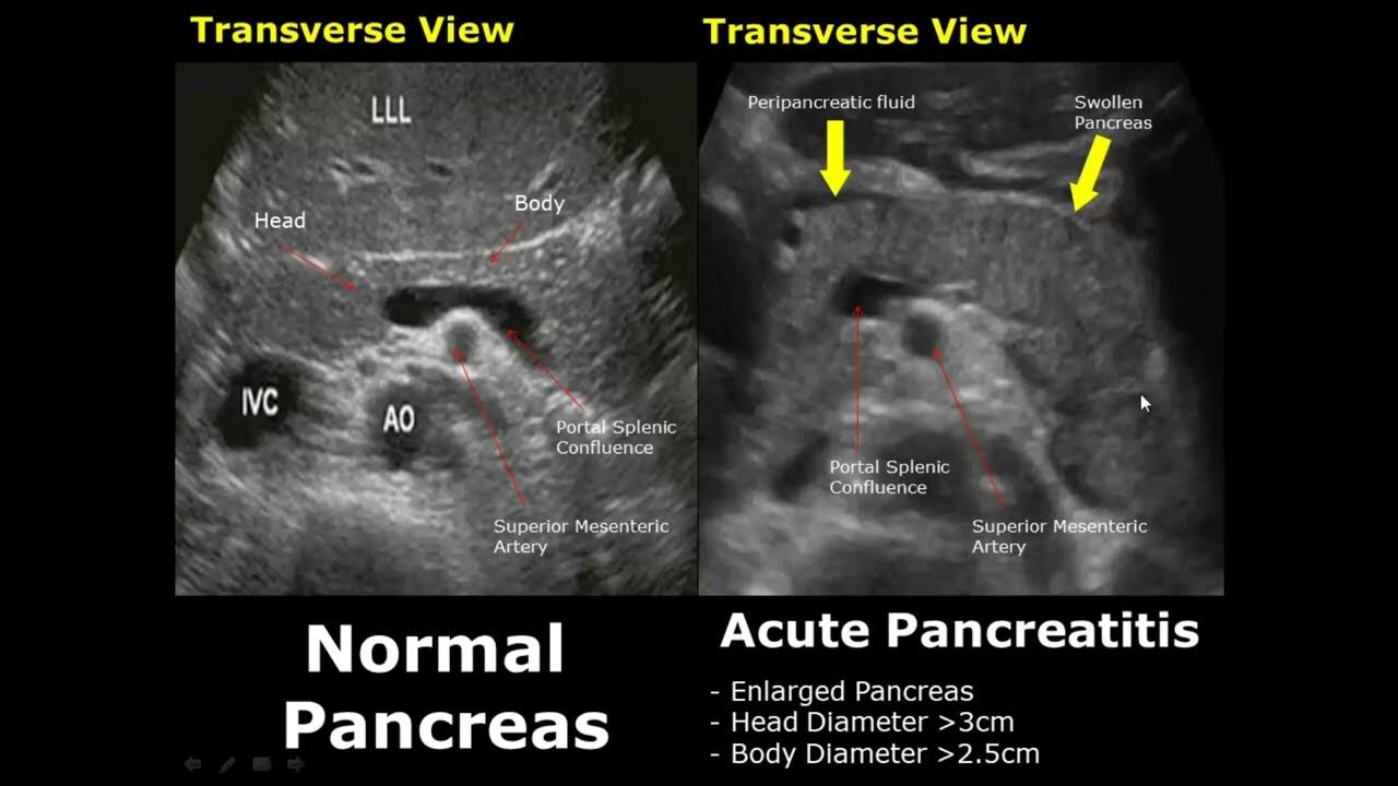 Pancreatic pseudocyst ultrasound