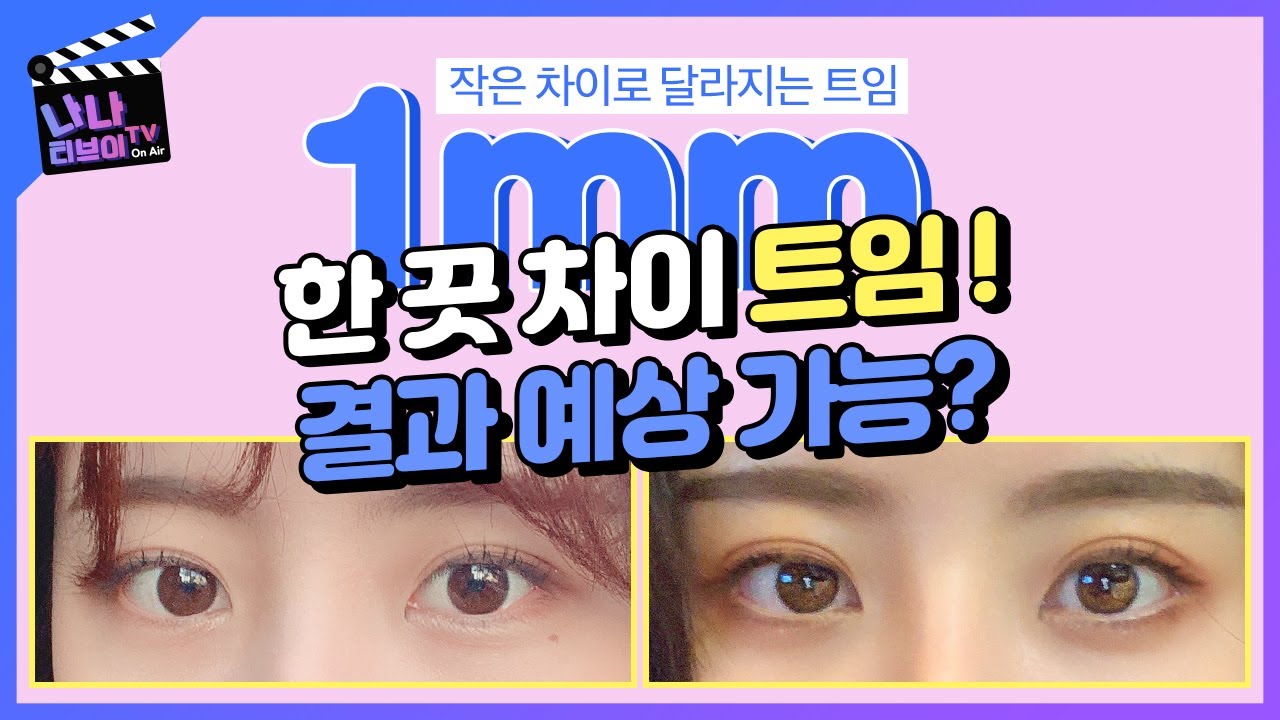 [앞트임/뒤트임] 눈성형의 완성은 트임!👀 성공 확률 자가진단 해볼 수 있을까요?