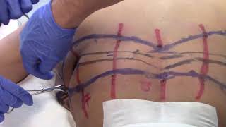 I developed this procedure in 2001. This procedure represents a sig...