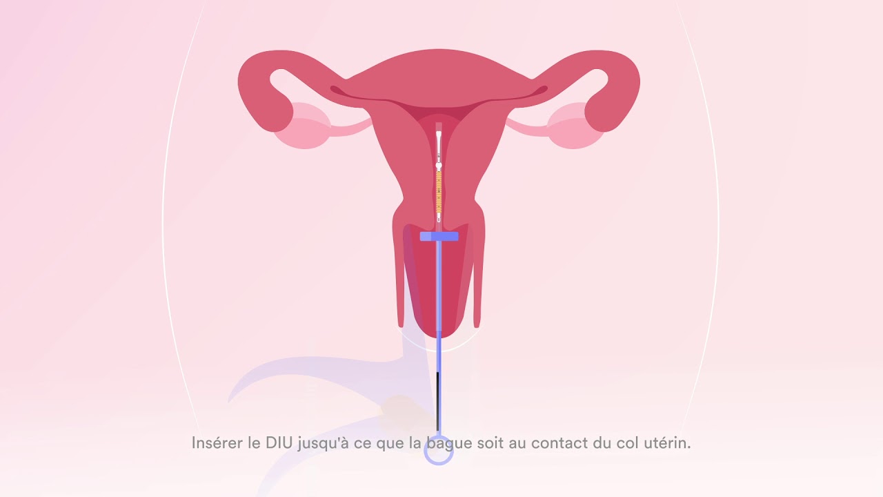 Technique de pose en deux temps - dispositif intra utérin UT380 CCD® /  NT380 CCD®