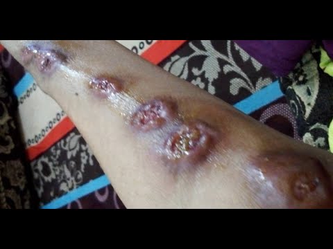 Penyakit Sporotrichosis senang saja rawatnya