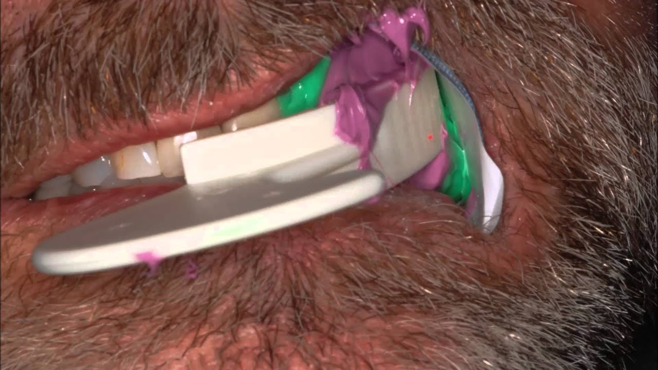 Garmer's saliva ejector setup