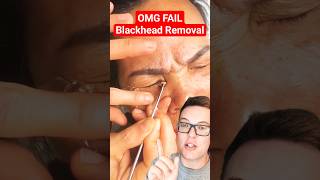 Crazy BLACKHEAD REMOVAL FROM EYE - Get A Dermatologist In #shorts