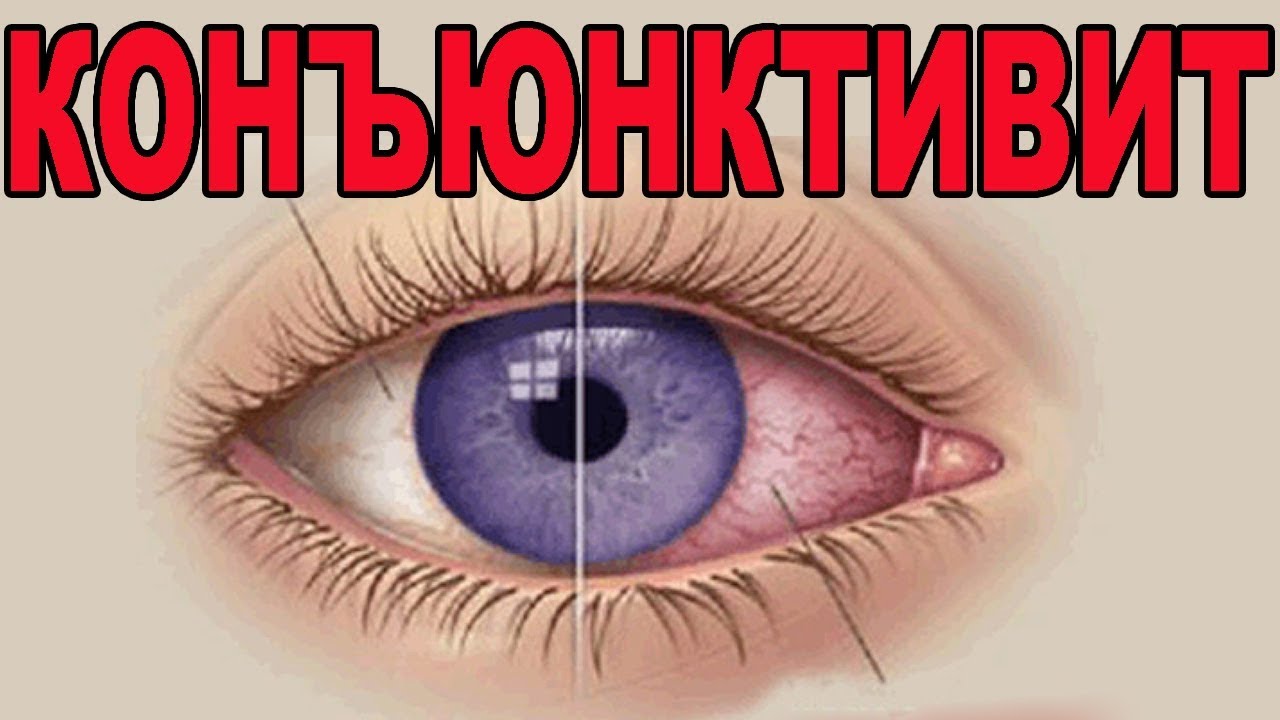 ЧТО ТАКОЕ КОНЪЮНКТИВИТ И ПОЧЕМУ ОН ВОЗНИКАЕТ - YouTube