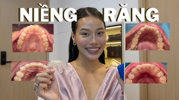 NIỀNG RĂNG TRONG SUỐT CÓ THỰC SỰ HIỆU QUẢ ?!? | RĂNG HÔ + MỌC CHEN CHÚC | MÌNH ĐÃ NIỀNG RĂNG XONG 💗