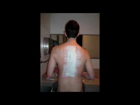 Seth minimally invasive scoliosis surgery