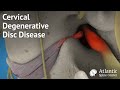 Cervical Degenerative Disc Disease