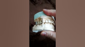 Thumbnail of 右上⑥5④ブリッジ 新潟市西区小針南台の西原歯科クリニック