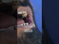 Leukoplakia buccal mucosa ,cautery ,laser - Dr Hitesh Patel