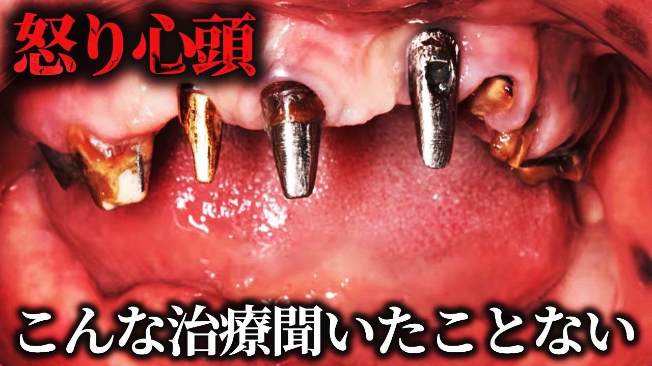 何度も外れるセラミック治療に怒り心頭！お口を抜本的に改革したらステキな事が起こりました編