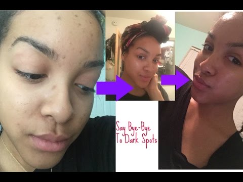 How I REMOVE MY ACNE DARK SPOTS | Lets Talk Hydrogen Peroxide | My Secret