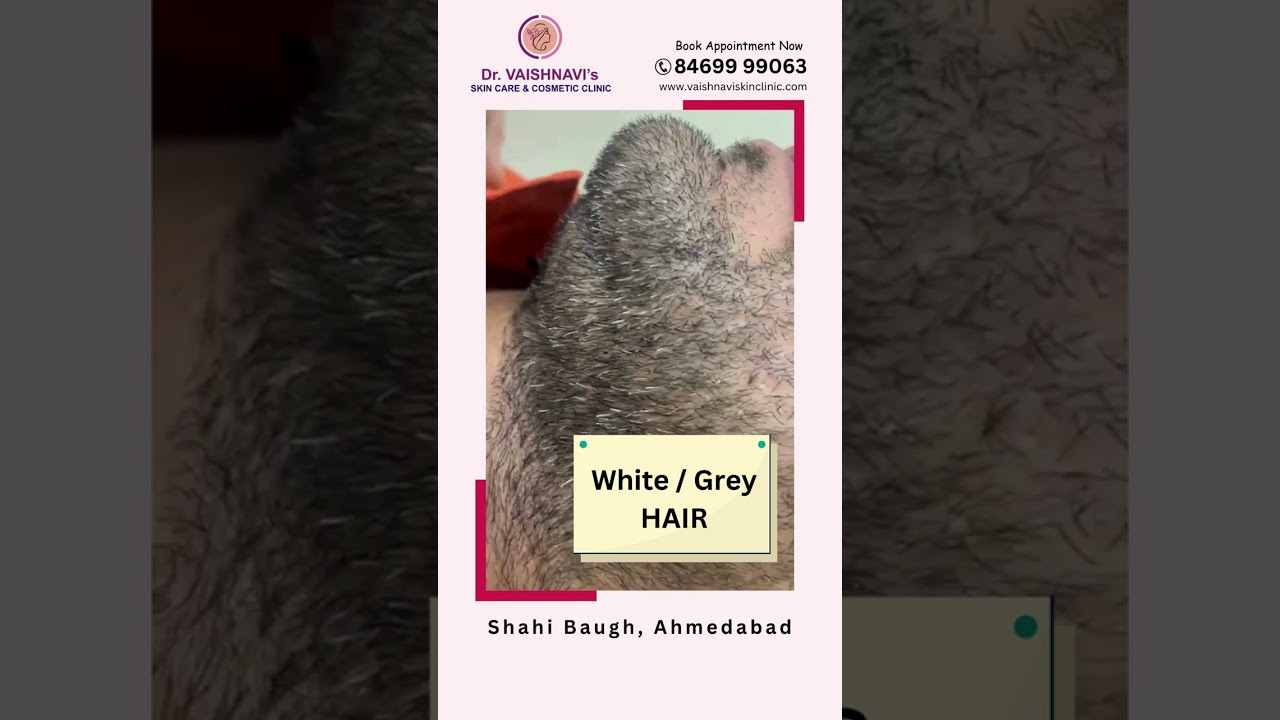 Get rid of white hair with RF electrolysis. #rfelectrolysis