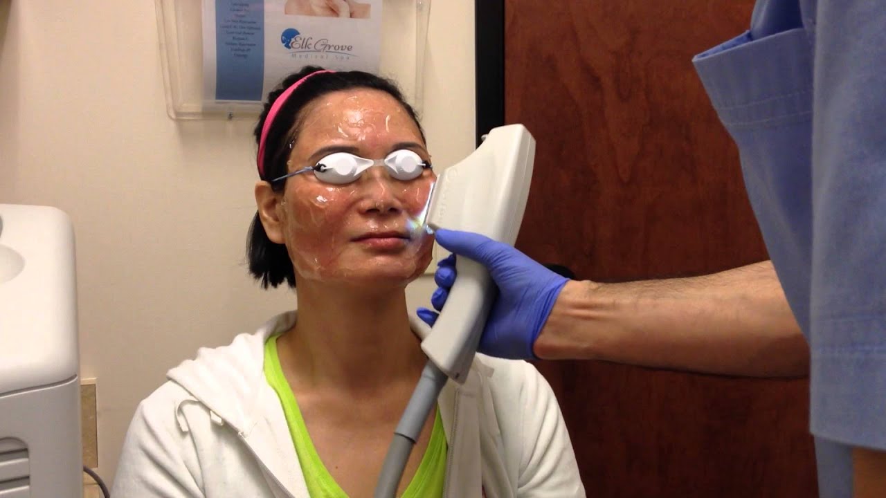 Broad band light treatment YouTube