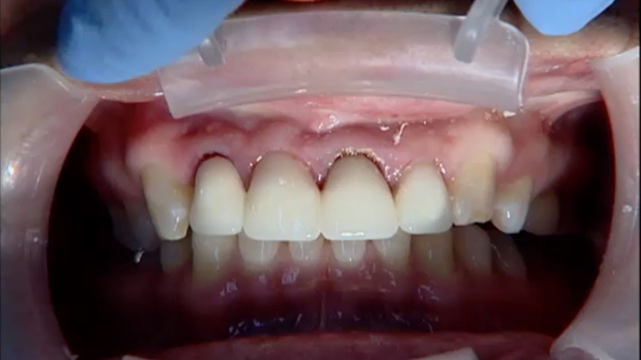 The Benefits of CAD CAM Restorations