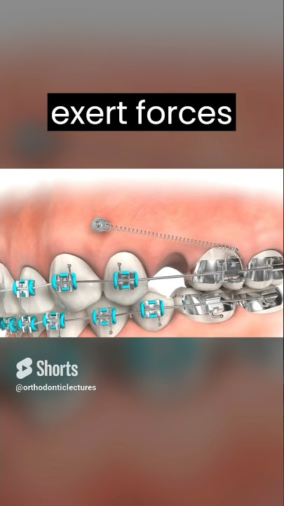 TADs 1 : The next level Orthodontic treatment technique
