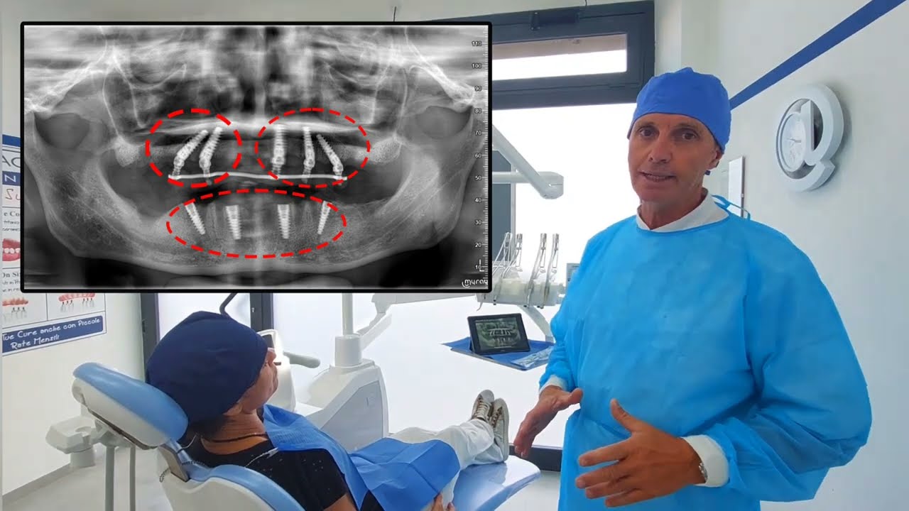 Impianti a carico immediato. Riabilitazione 2 arcate in un giorno