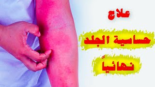 كيفية علاج حساسية الجلد نهائياً ؟