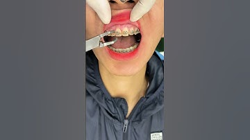 tháo mắc cài thôi nào #dentist #chinhnha #niengrang