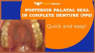 Posterior palatal seal ( PPS ) in complete denture & How to record it ?? #pps #completedenture screenshot 2