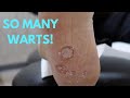 CALLUS, WARTS, AND NAIL CARE?! OH MY! **SURPRISE AT THE END**