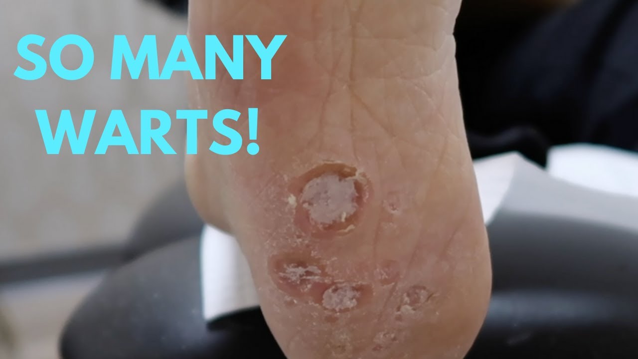 CALLUS, WARTS, AND NAIL CARE?! OH MY! **SURPRISE AT THE END** YouTube