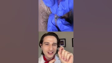 Big Blackhead Extraction. #dermreacts #pimplepopper