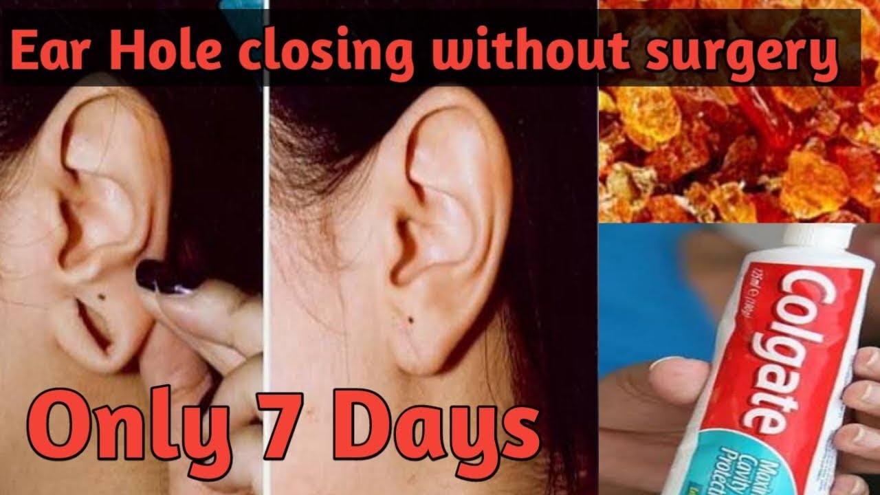 बड़े हुऐ कान का छेद छोटा करने का सबसे सटीक उपाय Ear Hole closing