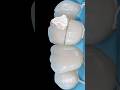 #endo #dentistry #endodontics #endodontics #rootcanal #pulpotomy #rct #pulpotomy