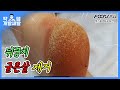 뒤꿈치 , 발바닥 굳은살 제거 관리 하기   removal callus [풋스올영등포당산점]