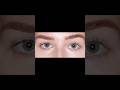 Mini Blepharoplasty With Hidden Crease Incision Subtle Lift No Visible Scar Refreshed Look 