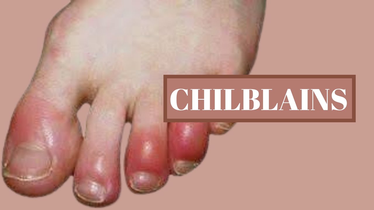 Chilblains In Adults : Diagnosis of Aicardi‐Goutières Syndrome in ...