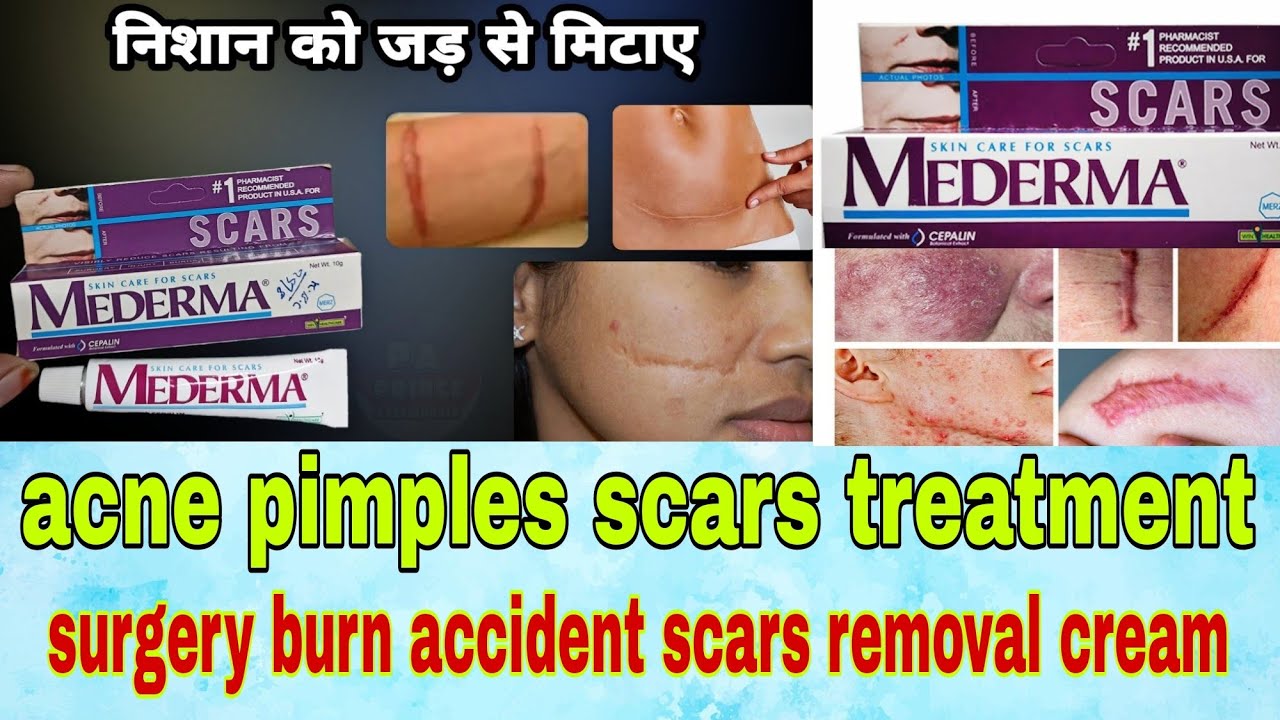 mederma cream uses in hindi acne pimples pores accident surgery