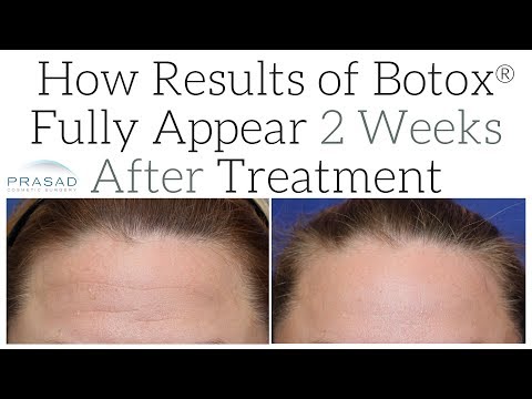 How Full Results of Botox® can Take 2 Weeks After Treatment to Appear