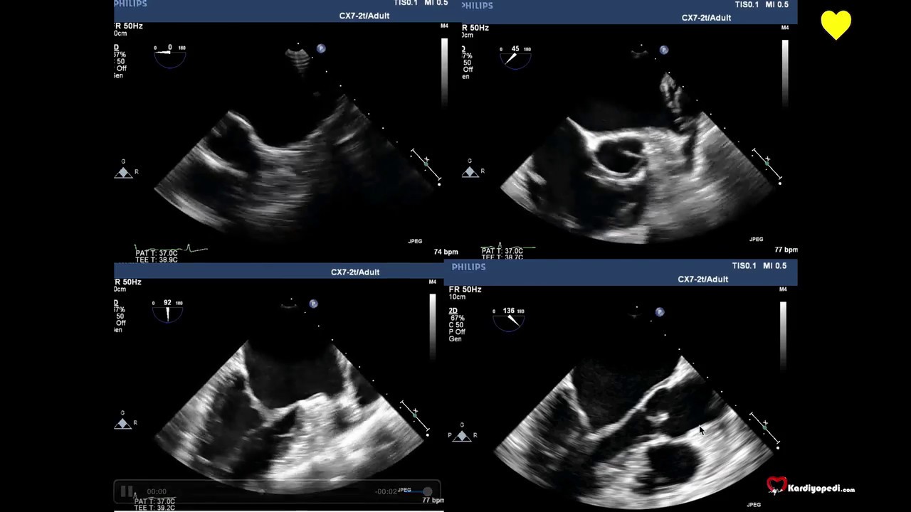 Sol Atriyal Apendiks'in TEE ile Değerlendirilmesi