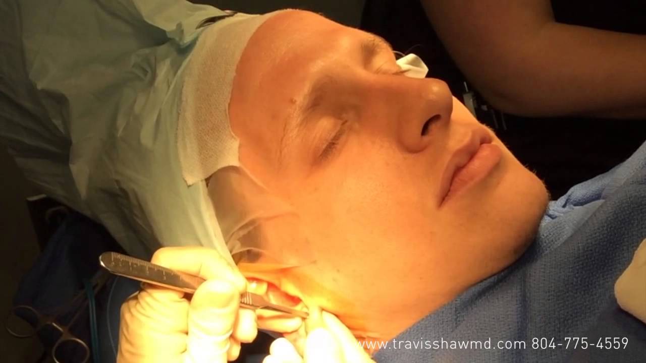 Gauged Ear Lobe Repair Richmond, VA YouTube