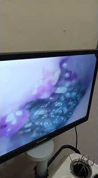 Larva lalat di liang telinga penderita telinga berair berulang