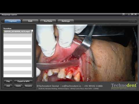 How The EKLER ELIO HDM Works - video from TEiDental