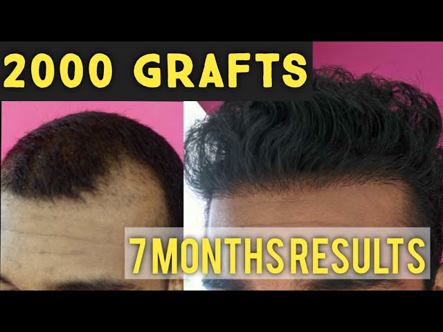Hair O Dent  FUE Hair Transplant  Kochi  Calicut  Results After 7  months of Hair Transplant WITHOUT USING MEDICINE  Full Results Timeline  Video from Day 1  Day