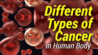 #1 Different Types of Cancer in Human Body screenshot 4