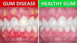 how to get rid of gingivitis at home gum disease natural cures