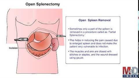 Splenectomy