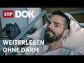 Colitis Ulcerosa – Moderator Robin Rehmann über seine Dickdarmentfernung | Reportage | SRF DOK