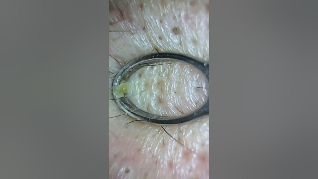 The Worst Gigantic Blackheads 2022 & Comedo Extraction YouTube