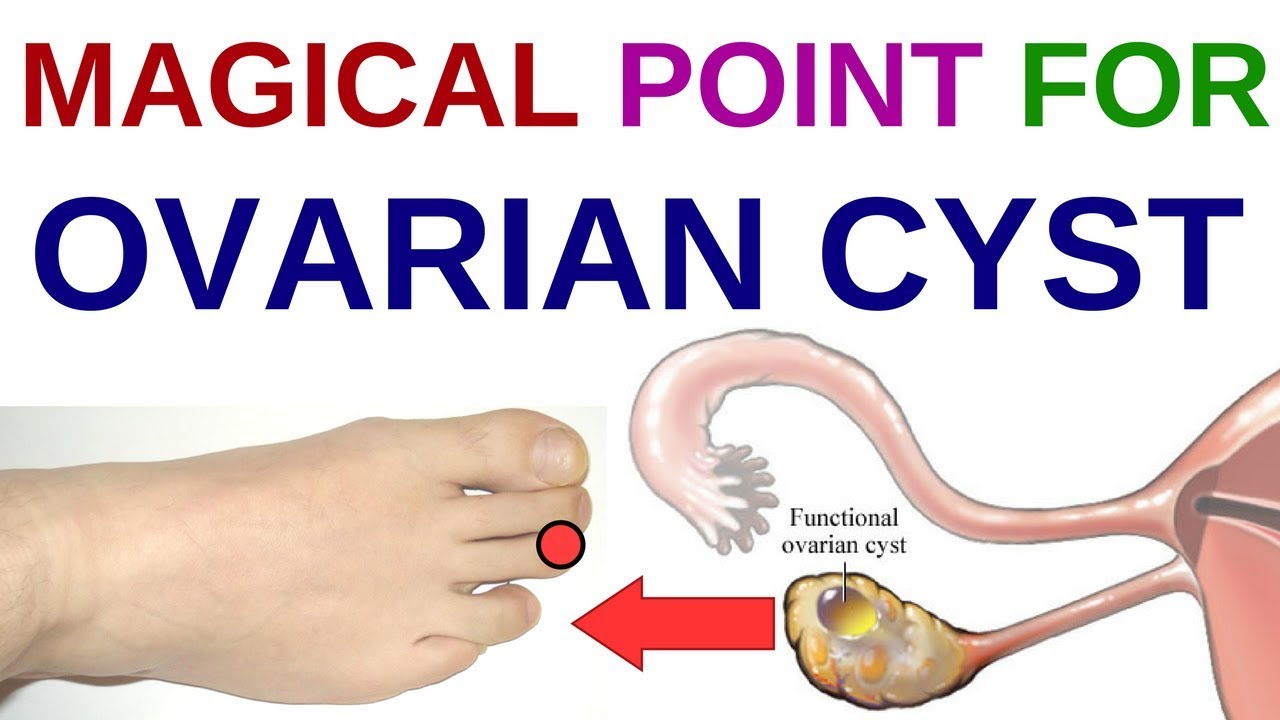 Reflexology Chart Ovarian Cyst - Acupressure Points For Pcos ...