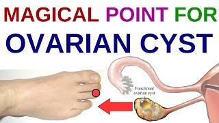 ACUPRESSURE POINTS For PCOS/Acupressure Points For OVARY CYST/Acupressure Points For OVARIAN CYSTS