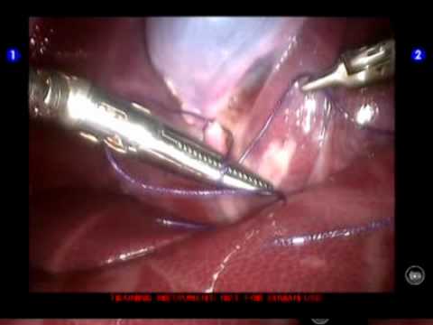 Robotic SILS Chole with EndoGrab Retraction-Dr. Ol...
